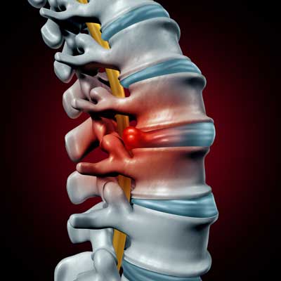 Vertebral Bulges and How to Treat Them