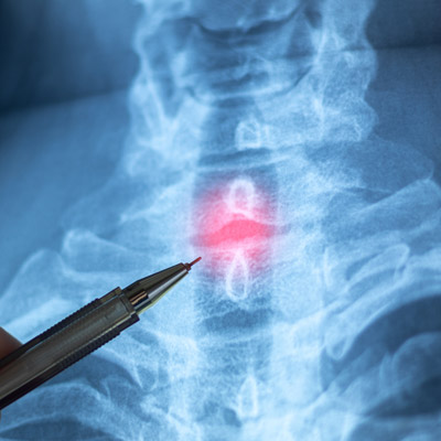 what is the best treatment for herniated discs in neck